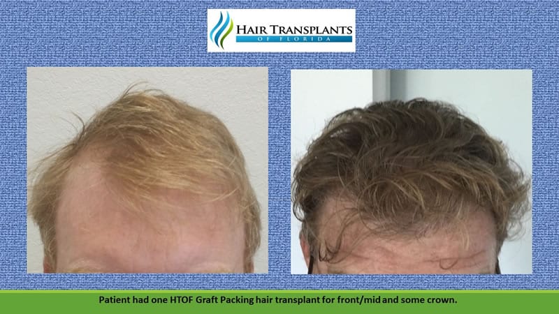 Clinic-provided before and after comparison of a patient’s hairline
