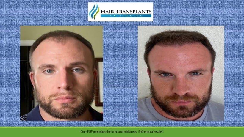 Clinic-provided before and after portrait of a hair transplant patient