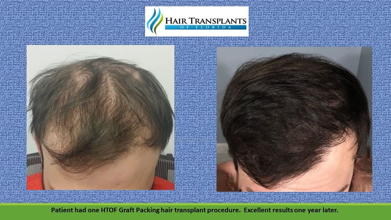 Clinic-provided before and after hair transplant photograph showing the same patient’s hair from above