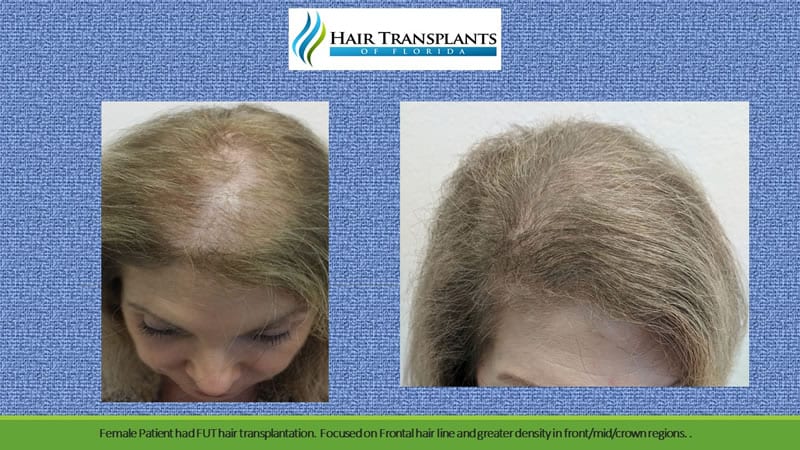 Clinic-provided before and after comparison showing a patient’s hair from above